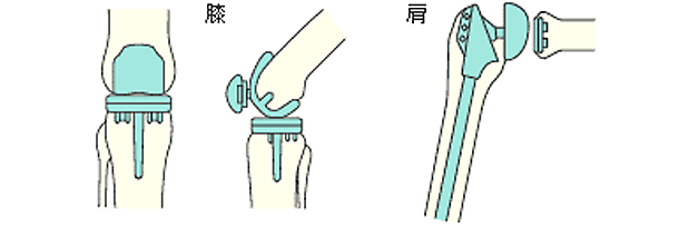 膝、肩などの人工関節置換術