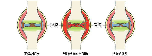 正常な関節と滑膜が腫れた関節と滑膜切除後の図