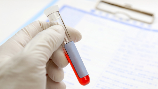 リウマチの血液検査と画像検査